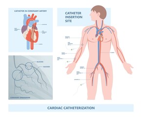 Angiography medical operation Angiogram Biopsy Angioplasty Stent Congenital Heart Defect Ablation CAG arteries plaque X-ray flow diagnose diagnosis blocked CABG valve atrial attack afib infarction