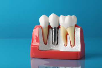 Educational model of gum with dental implant between teeth on light blue background