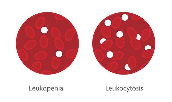 Leukocytosis and leukopenia illustration in a sample of blood. Blood disorder in the White blood cells concentration