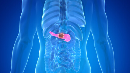 3d rendered medically accurate illustration of pancreas cancer