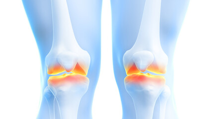 3d rendered illustration of painful knee joints