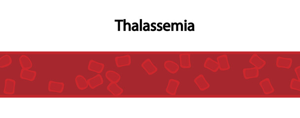 Thalassemia Anemia representation in a blood vessel