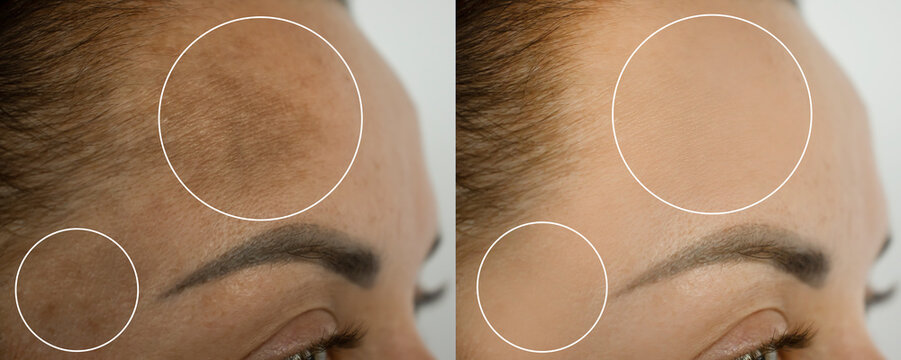 woman forehead pigmentation before and after treatment