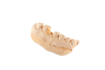 Plaster model of a part of a human jaw. Dental prosthesis from  gypsum model.
Plaster model of...