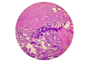 Adenocarcinoma. Photomicrograph. Histology. Microscopic slide view.