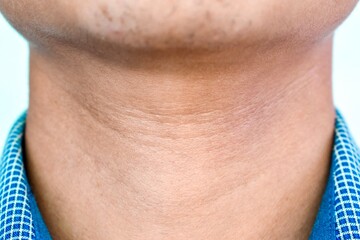 Aging skin folds or creases or wrinkles at neck of Asian young man.