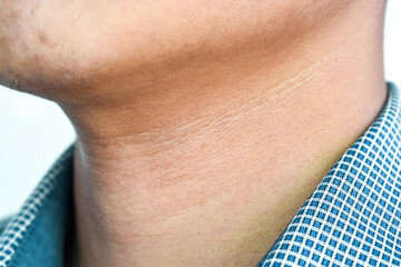 Aging skin folds or creases or wrinkles at neck of Asian young man.