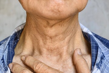 Fototapeta premium Aging skin folds or skin creases or wrinkles at neck of Asian old man. Concept of sore throat.