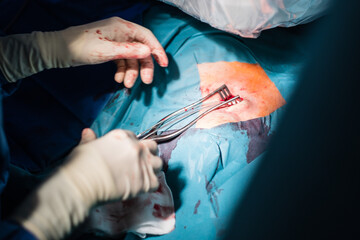 Wunde mit Klammern bei einer Operation im Krankenhaus