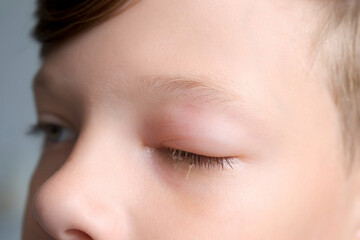 Face of boy with a swollen eye from an insect bite, closeup view. Allergy to insect bites. Closed red sick eye of a teen boy. Eye disease in a child, conjunctivitis, inflammation in the eye. - obrazy, fototapety, plakaty