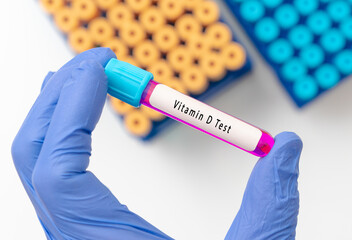 Vitamin D  test result with blood sample in test tube on doctor hand in medical lab
