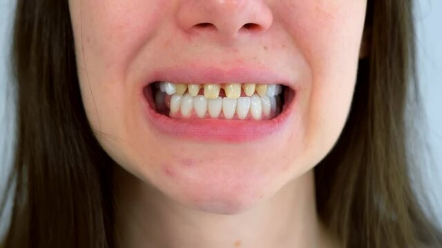 Mouth of young woman with yellow bad teeth preparing to install ceramic veneers. Teeth sharpened by dentist before installing crowns and veneers. Dentistry treatment, prosthetics of teeth concept.