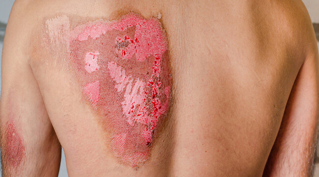 Second-degree burns on male back caused by heat. Medical concept.