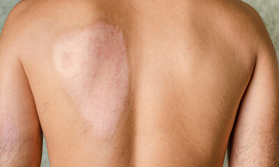 Healed car after second degree skin burn on male back. Medical and healthcare concept