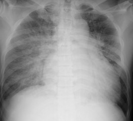 x ray image of pulmonary edema and cardiomyopathy