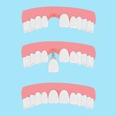 Vector  Teeth with Implant Closeup Isolated on White Background. Dentistry and Orthodontics Design. Human Teeth for Medical Prosthetics Concept
