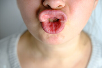 close-up of Curved teeth of young woman before installing braces, girl with smile on lips, concept...