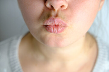 close-up of Curved teeth of young woman before installing braces, girl with smile on lips, concept...