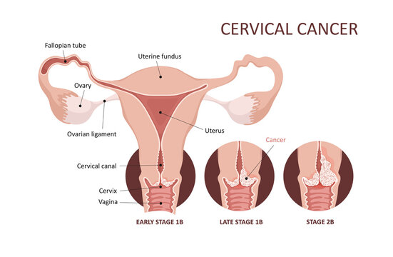 Cervical cancer development image. Cervix carcinoma stages. Female reproductive system. Anatomy. Gynecology.