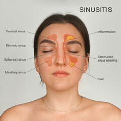 Sinusitis. Healthy and inflammation nasal sinus. Medical diagram. - obrazy, fototapety, plakaty