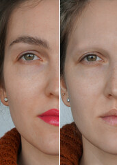 Portrait of a girl before and after illness. Аlopecia