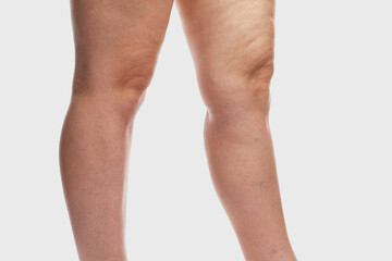 Fototapeta na wymiar Thick female legs with cellulite and varicose veins. Overweight and disease. Close-up. Isolated on a light gray background.