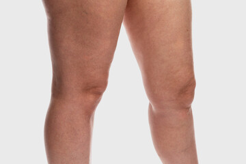 Thick female legs with cellulite and varicose veins. Overweight and disease. Close-up. Isolated on a light gray background.