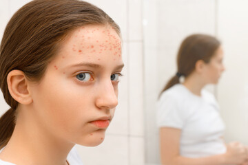 face of a teenage girl with pimples, acne on the skin, concept of beauty and health