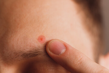 Fototapeta premium Pimple on the man's forehead above eyebrow. Designated by color close-up