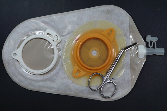 Urostomy And  Nephrostomy Bag - Ostomy Medical Care Equipmen: Two-piece Urostomy Bag With The Valve Adhered To The Skin Of The Patient. Ostomy Plate For Fixing Urostomy Bag