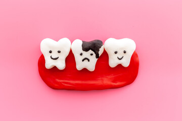 Oral health concept. Healthy and caries teeth models on gums