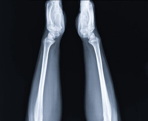 Lumbar Vertebra X-ray (Bidirectional)