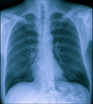 Radiographic image or X-Ray Image of Human Chest