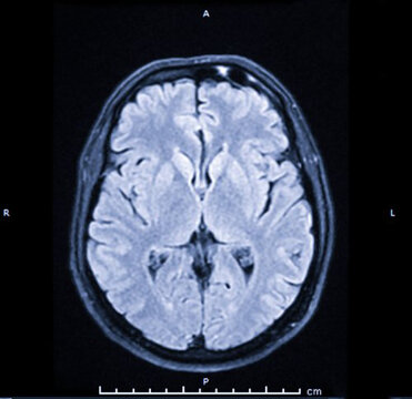 Brain MRI scan. Scanning of brain's magnetic resonance image. Diagnostic Medical Tool