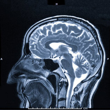 magnetic resonance image (MRI) of the brain - side view image