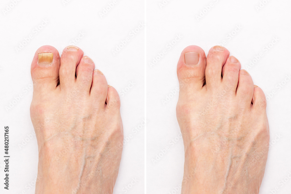 Wall mural Close-up of a male foot with yellow ugly fungus on toenails and healthy nails before and after treatmet isolated on a white background. Fungal nail infection.
Advanced stage of disease. Top view