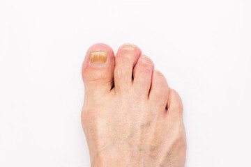 Close-up of a male foot with yellow ugly fungus on toenails isolated on white background. Fungal nail infection caused by excessive sweating, nail injury,
Advanced stage of disease. Top view - obrazy, fototapety, plakaty