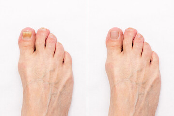 Close-up of a male foot with yellow ugly fungus on toenails and healthy nails before and after treatmet isolated on a white background. Fungal nail infection.
Advanced stage of disease. Top view - obrazy, fototapety, plakaty