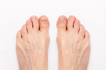 Close-up of a male foot with yellow ugly fungus on toenails and healed nails before and after treatmet isolated on a white background. Fungal nail infection.
Advanced stage of disease. Top view - obrazy, fototapety, plakaty