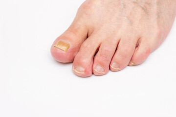 Close-up of a male foot with yellow ugly fungus on toenails isolated on white background. Fungal...