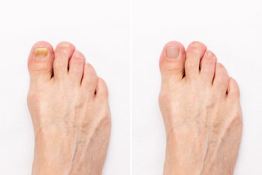 Close-up of a male foot with yellow ugly fungus on toenails and healthy nails before and after treatmet isolated on a white background. Fungal nail infection.
Advanced stage of disease. Top view