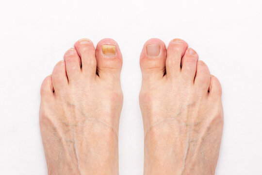Close-up of a male foot with yellow ugly fungus on toenails and healed nails before and after treatmet isolated on a white background. Fungal nail infection.
Advanced stage of disease. Top view