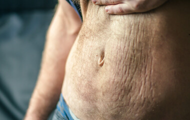 man with strech marks after waight loss,