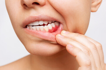 Gum inflammation. Cropped shot of a young woman showing red bleeding gums isolated on a white...