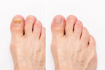 Macro shot of a male foot with yellow ugly fungus on toenails and healthy nails before and after treatmet isolated on a white background. Fungal nail infection. Advanced stage of disease. Top view - obrazy, fototapety, plakaty
