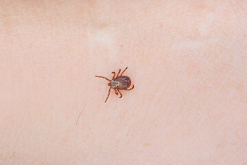 A tick on the human body.