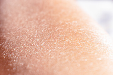 Concept of extremely dry and dehydrated skin of the body. Problematic skin diagnosed with xerosi or...