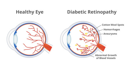 Vector illustration of diabetic retinopathy, a complication of diabetes caused by high blood sugar and normal healthy eye isolated. Cotton wool spots, hemorrhages, aneurysms, abnormal blood vessels.