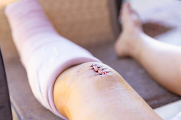 new incision and scar after knee surgery, selective focus.