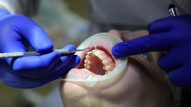 The procedure of augmentation of the front teeth, the patient is 11 years old. The child is sitting in a dental chair.